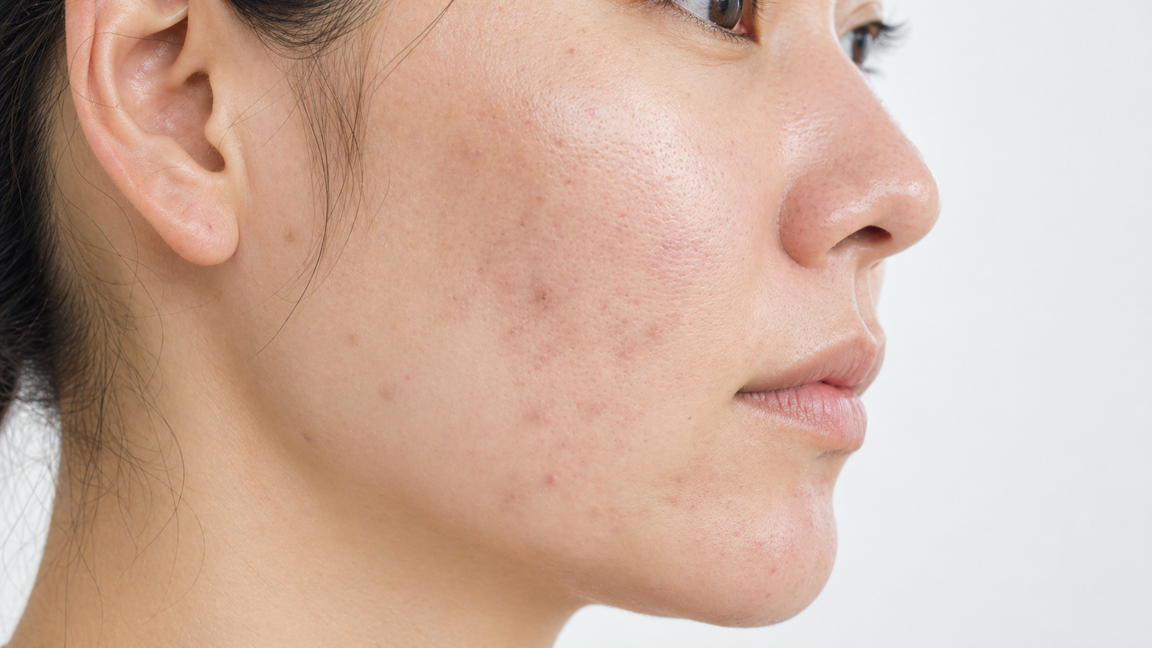 Acne-prone cheek profile used for a Rico pore-clogging ingredient check