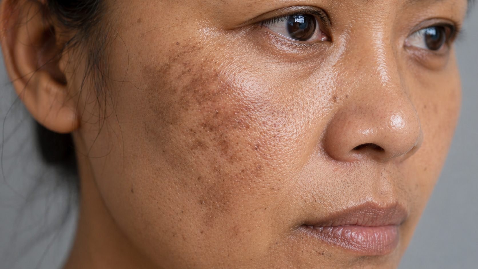 Hyperpigmentation skin concern illustration